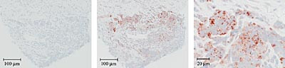Figur 2    TSA brukt p&aring; vevssnitt fra bronkialbiopsier ved mistenkt nevroendokrint karsinom (sm&aring;cellet karsinom) i lunge.  a&hellip;