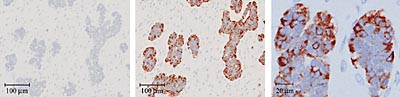 Figur 3    Vevssnitt fra en ovarialtumor som man mistenkte var av nevroendokrin opprinnelse.  a) Imidlertid viste svulsten&hellip;