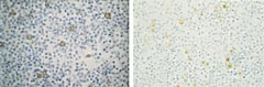 Figur 2  Immunhistokjemisk fargede snitt av formalinfiksert, parafininnst&oslash;pt cytoblokk.  a) Positivitet for CA 125.  b)&hellip;