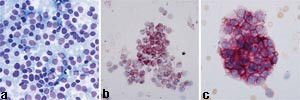 Figur 6    Finn&aring;lsaspirasjonscytologi fra pasient 3. Sm&aring;cellet malign tumor (a). Immunhistokjemisk unders&oslash;kelse viste&hellip;