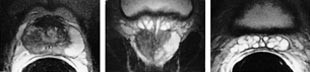 Figur 2  a) Aksialt endorektalt MR-bilde (T2-vektet) av prostata viser hypointens tumor i den perifere sone p&aring; h&oslash;yre side&hellip;