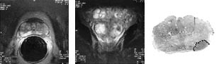 Figur 5  a) Et aksialt og b) koronalt endorektalt MR-bilde av prostata viser en liten tumor p&aring; venstre side hvor man mente&hellip;