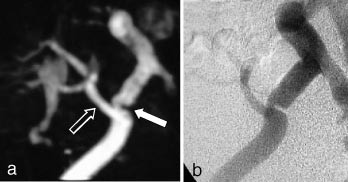 Figur 8  a) Kontrastforsterket MRA av arterieforsyningen til transplantert nyre. Det er en markert stenose (lukket pil) p&aring; a&hellip;