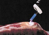  Figur 2    Argonplasma-koagulasjon. Proben (lys bl&aring;) er f&oslash;rt gjennom et fleksibelt endoskop og holdes i en avstand p&aring; 2 &ndash;&hellip;