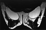 Figur 6    T2-vektet bilde i transversalplan av bryst med silikonimplantater. Pilen peker p&aring; en liten innfolding i&hellip;