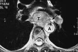 Figur 2    Oesophaguscancer. Svulsten (T) infiltrerer inn i aorta (piler) (A). Det er mulig &aring; se to lag i veggen av aorta,&hellip;