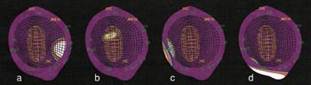 Figur 3  Nylig har vi tatt i bruk et databasert registreringssystem (EnSite3000TM, Endocardial Solution Inc.). Etter at&hellip;