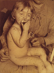 Figur 2   Et barn med koppelesjoner over hele kroppen (Finseninstituttet, Danmark, 1890-&aring;rene). Utover p&aring; 1800-tallet var&hellip;