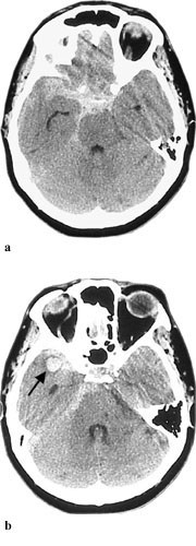 Figur 2   Cerebral CT viser  a) bl&oslash;dning fra aneurisme ved h&oslash;yre a. cerebri mediatrifurkatur med blod i basale cisterner og&hellip;