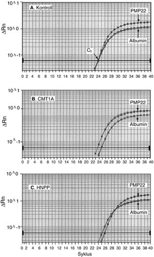 Figur 2   Sanntid (real-time) kvantitativ PCR-amplifikasjonsplot av genet PMP22 mot albumin som referansegen. A) normal&hellip;
