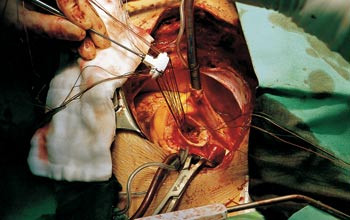 Innsetting av aortaventil er blitt et hjertekirurgisk rutineinngrep. Bildet fra en hjerteoperasjon ved St. Elisabeth&hellip;