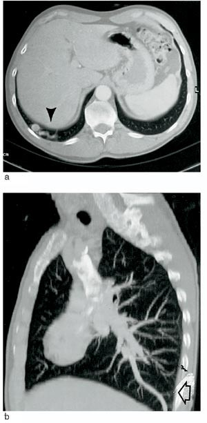 Figur 2  a) CT thorax med aksiale snitt viser patologiske blodkar nedad svarende til posterobasale underlappssegment i h&oslash;yre&hellip;