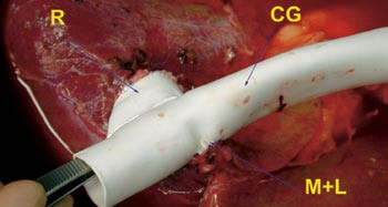 Figur 3  Ex situ erstattes v. cava av en 22 mm PTFE-protese. En mindre protese interponeres mellom cavaprotesen og h&oslash;yre&hellip;