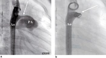 Figur 2  a) Angiokardiogram med injeksjon av kontrastmiddelet i aorta (Ao). Arteria pulmonalis (PA) vert fylt gjennom den&hellip;