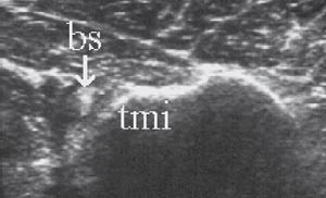 Figur 12  Ventral-transversal projeksjon. Bicepssenen (bs) er luksert medialt over tuberculum minus (tmi)