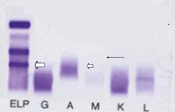 Figur 2  Serumimmunfiksasjonselektroforese. P&aring;visning av sm&aring; mengder av komplett IgG-&kappa; katodisk i &gamma;&thinsp;-sonen (&lArr;) og&hellip;