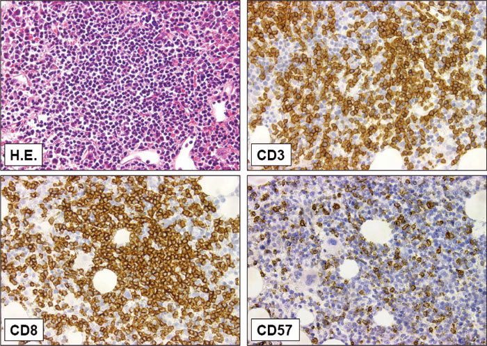 Figur 3  Beinmargsbiopsi fra pasient med storcellet granul&aelig;r lymfocytt-leukemi med omfattende beinmargsaffeksjon. Snitt&hellip;