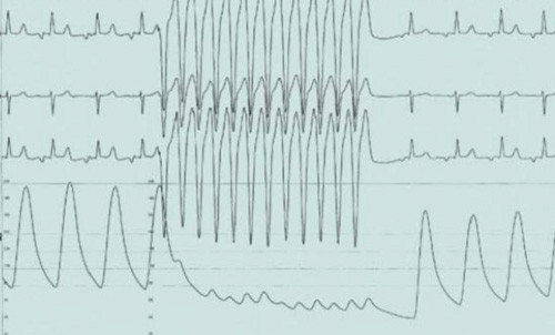 Figur 3  EKG og aortatrykk ved hurtig pacing med tempor&aelig;r pacemaker