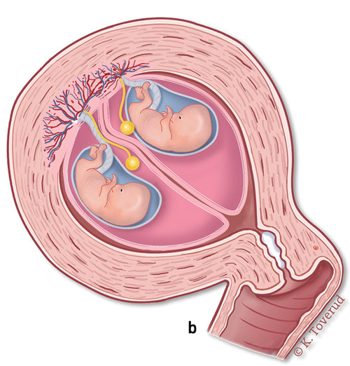 Figur 1 b) En felles placenta/to fostersekker.