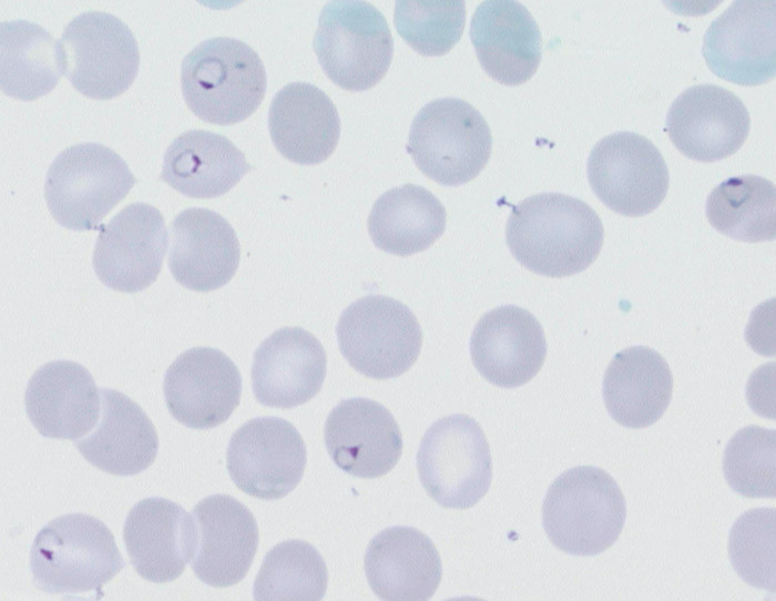 Figur 1  Plasmodium falciparum-ringformer i perifert blodutstryk hos gravid kvinne med alvorlig malaria og 14 % parasittemi&hellip;