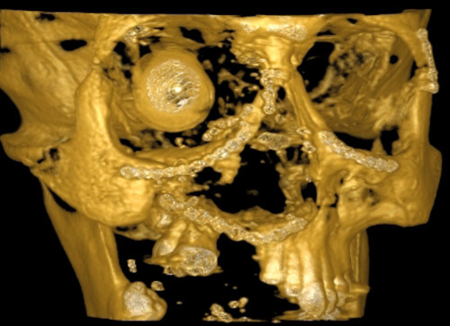 Figur 1  CBCT 3D-rekonstruksjon av midtansikt