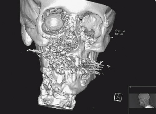 Figur 2  CT 3D-rekonstruksjon av midtansikt