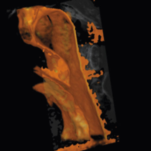 Figur 4  CBCT 3D-rekonstruksjon av strupehode og svelg