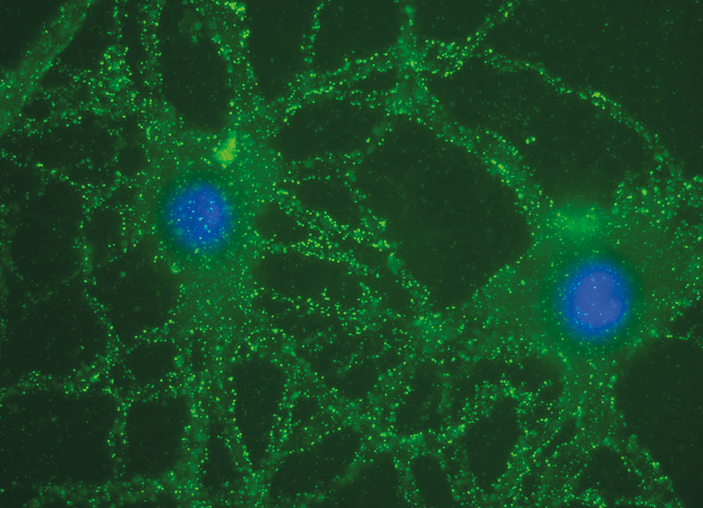 Figur 2  To nevroner i en cellekultur fra rottehippocampus som er immunfarget med spinalv&aelig;ske fra en pasient. De multiple,&hellip;