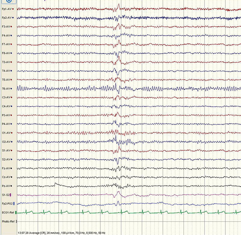 Figur 2  EEG fra fors&oslash;ksperson med akutte depressive perioder. Normal bakgrunnsaktivitet. Ett enkelt kort, generalisert&hellip;