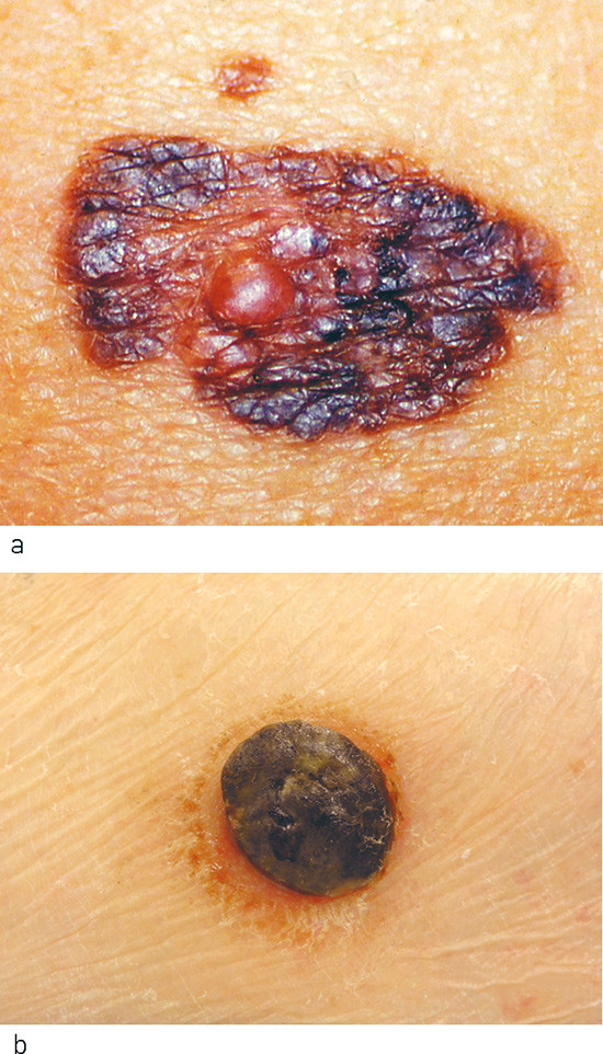 Figur 2  Hovedtyper av kutane prim&aelig;re maligne melanomer: a) Superfisielt spredende malignt melanom og b) nodul&aelig;rt malignt&hellip;