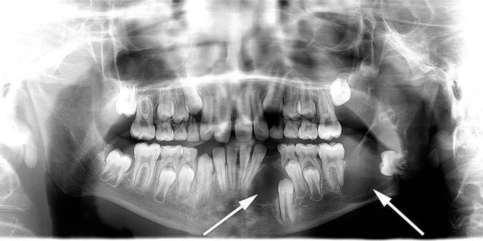 Figur 2  Illustrasjonsfoto av kjevecyster. Ortopantomografi (OPG) av gutt med diagnostisert Gorlins syndrom. P&aring; bildet ser&hellip;