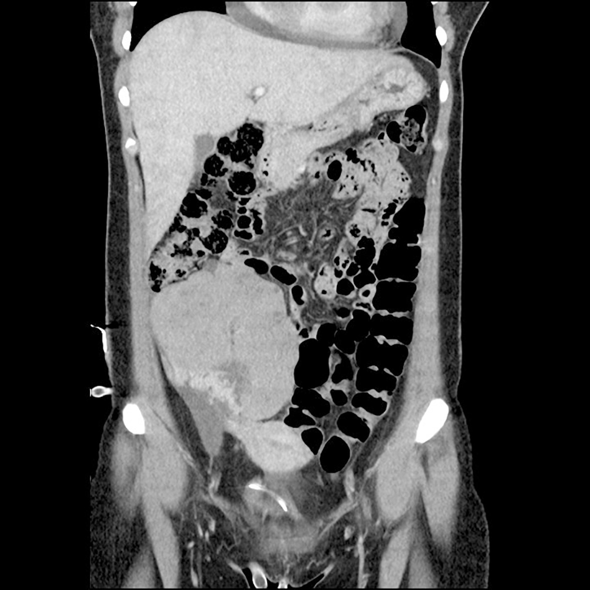 Figur 2 CT abdomen i frontalplan ved diagnosetidspunkt. CT-unders&oslash;king av pasienten tatt etter innkomst viste ei stor&hellip;