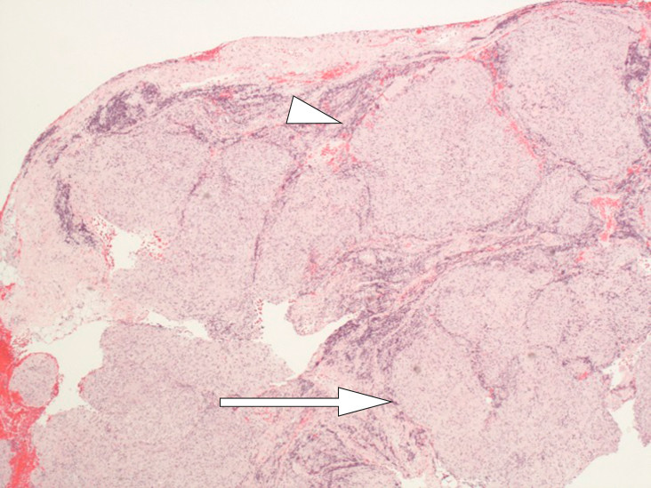 Figur 6 Oversikt lymfeknute med granulomat&oslash;s betennelse: tettpakket med ikke-nekrotiserende velformede&hellip;