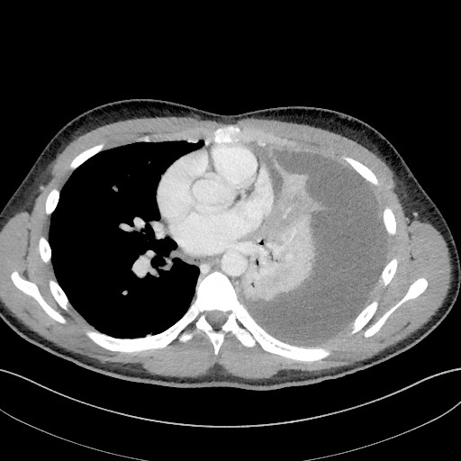 Figur 1 CT thorax tatt &eacute;n uke etter innleggelse viste at n&aelig;r hele venstre thoraxhule var fylt med ekspansivt preget&hellip;