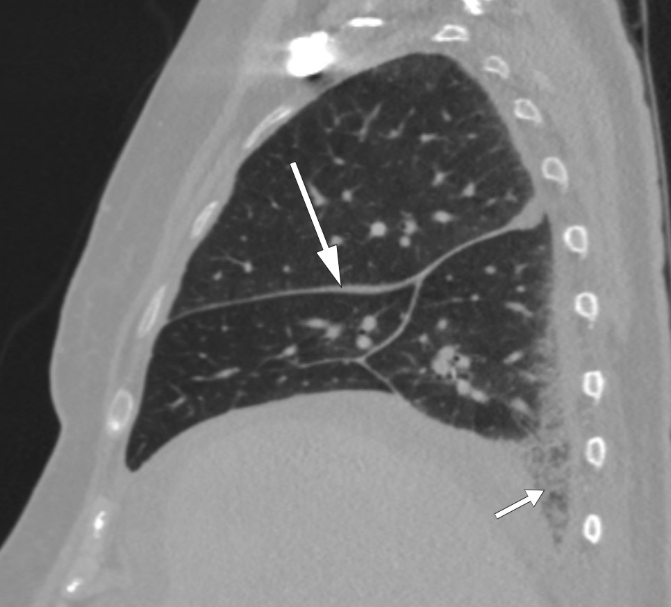 Figur 2 CT thorax som viser jevn fortykkelse av interlobul&aelig;re spalter (lang pil) og retikul&aelig;re forandringer basalt i h&oslash;yre&hellip;