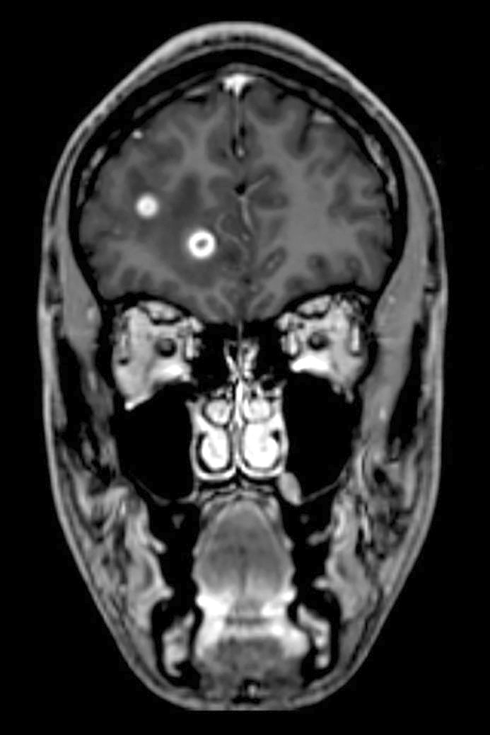 Figur 2 T1-vektet volumetrisk magnetisk resonanstomografi av hjerne og medulla, tatt med kontrastmiddel. Bildet viser&hellip;