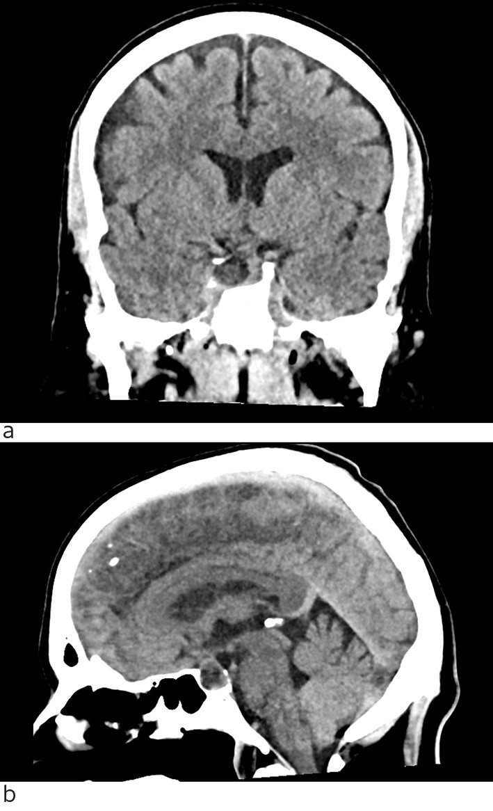 Figur 2 CT caput uten intraven&oslash;st kontrastmiddel. a) koronalt snitt, b) sagittalt snitt. Ekspansiv lesjon i sella turcica&hellip;