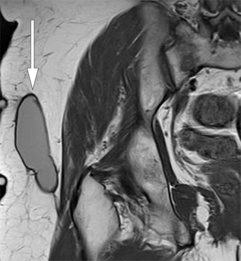 Figur 1 Koronal T1-vektet MR av h&oslash;yre hofteregion. Velavgrenset, avlang, linseformet struktur med homogent intermedi&aelig;rt&hellip;