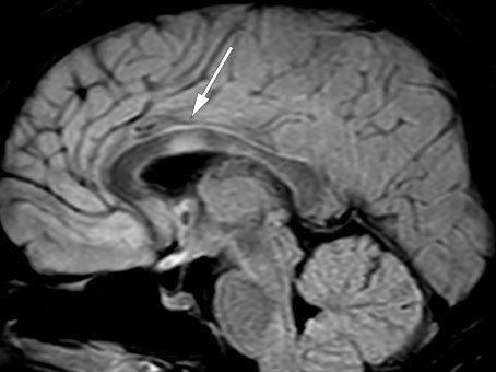 Figur 4 Lesjon i corpus callosum p&aring; sagittal FLAIR-MR-unders&oslash;kelse.