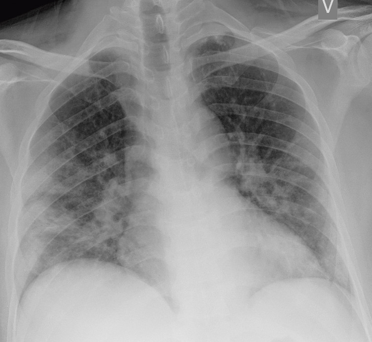 Figure 1 Patient with COVID-19 hospitalised with reduced general condition, dry cough and increasing dyspnoea. Prone bedside&hellip;