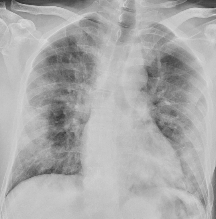 Figur 2 Pasient med covid-19 innlagt etter ti dager med hodepine og t&oslash;rrhoste, siste tre dager &oslash;kende dyspn&eacute;. R&oslash;ntgen thorax&hellip;