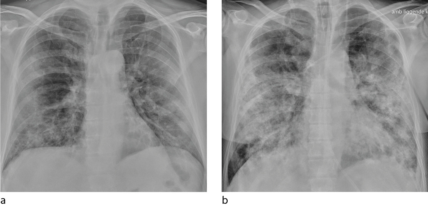Figur 3 a) Pasient med covid-19. R&oslash;ntgen thorax tatt sittende i seng med mobilt apparat 10 dager etter symptomdebut viser&hellip;