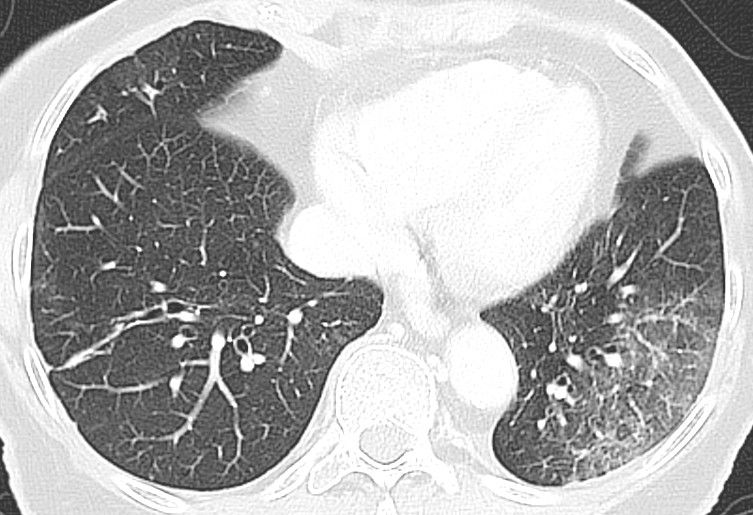 Figure 4 Patient with COVID-19 with reduced general condition, nausea, vomiting, syncope and possible chills. CT thorax two&hellip;