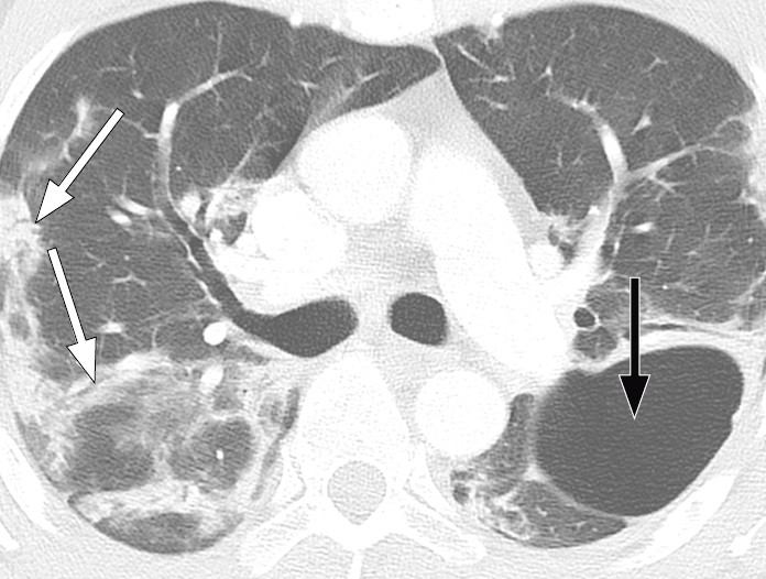 Figur 6 Pasient med Covid-19. CT thorax 20 dager etter symptomdebut viser bilaterale fortetninger med perifer og&hellip;