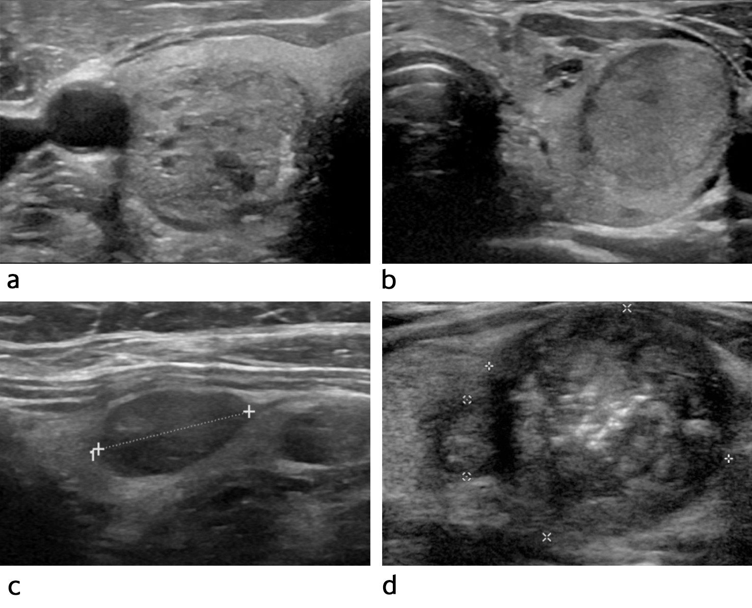 Figur 1 Typiske ultralydfunn ved ulike klassifiseringer av risiko for malignitet i tyreoidea (TIRAD = Thyroid Imaging&hellip;