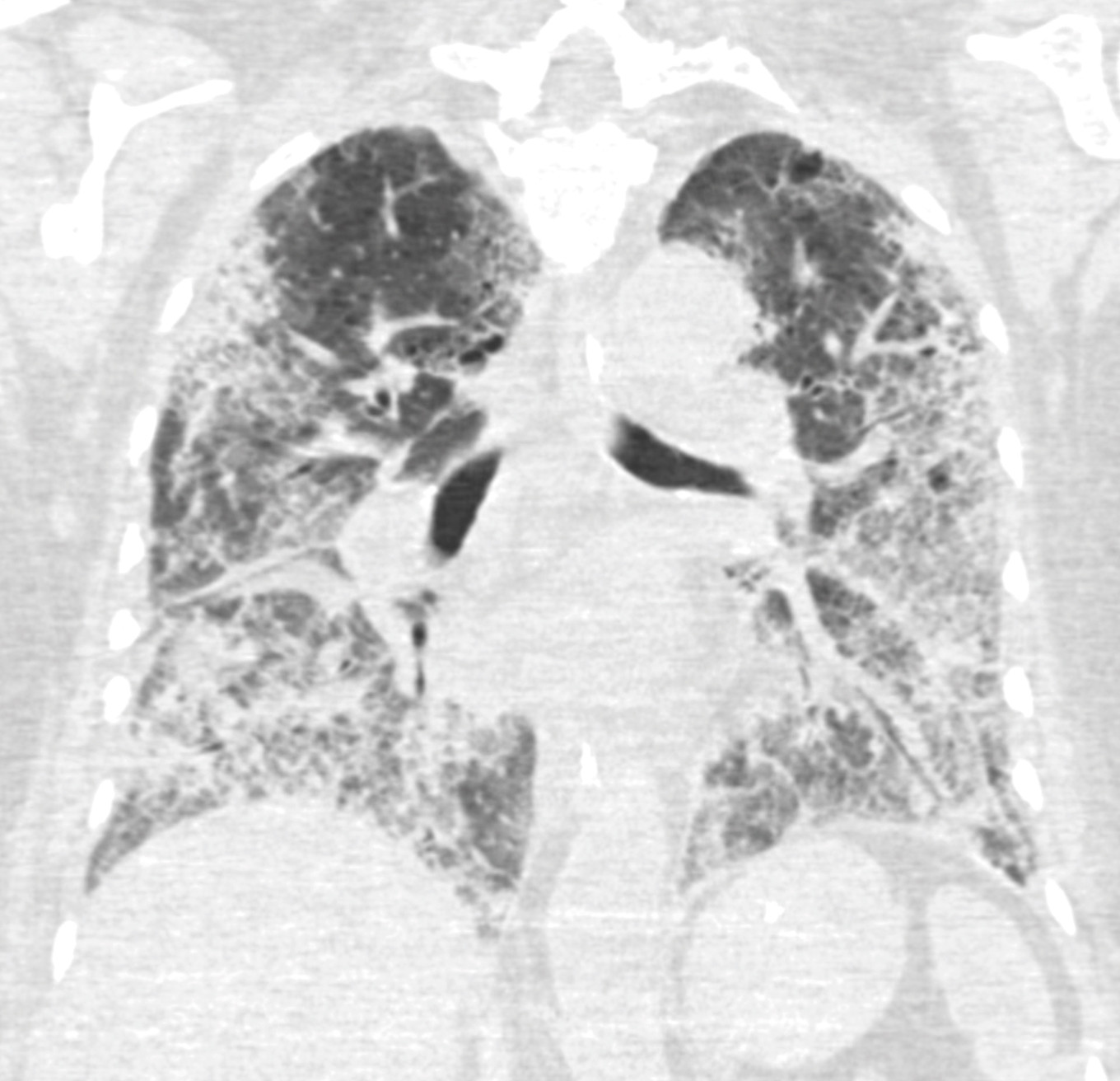 Figur 2 Frontalsnitt av CT thorax tatt 28 dager etter symptomdebut, 17 dager etter innleggelse og 14 dager etter at&hellip;