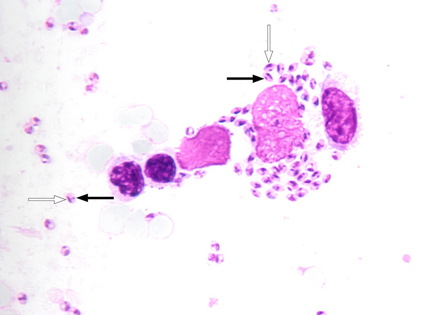 Figur 1 Lysmikroskopi av miltbiopsi fra pasient med Leishmania-amastigoter, der en kan se cellekjerne (hvit pil) og den&hellip;