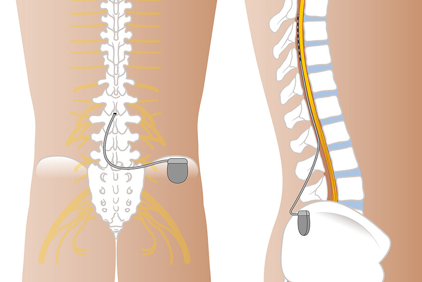Figur 1 Ryggmargsstimuleringssystem med epidural elektrode og subkutan pulsgenerator. Illustrasjon: &Oslash;ystein Horgmo,&hellip;