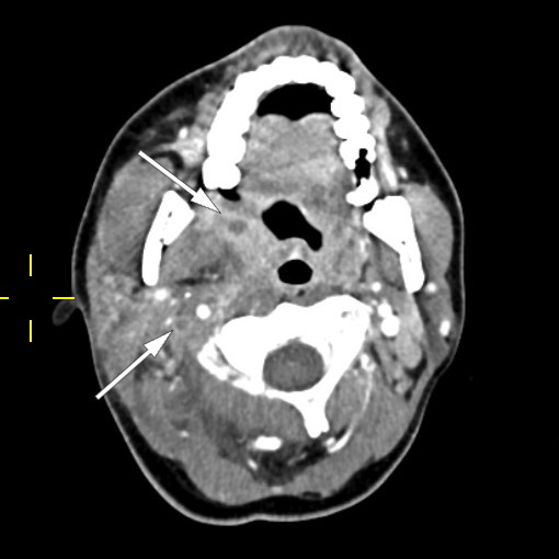 Figur 1 CT collum av v&aring;r pasient med Lemierres syndrom, tatt p&aring; f&oslash;rste innleggelsesdag. Bildet viser peritonsill&aelig;r abscess&hellip;