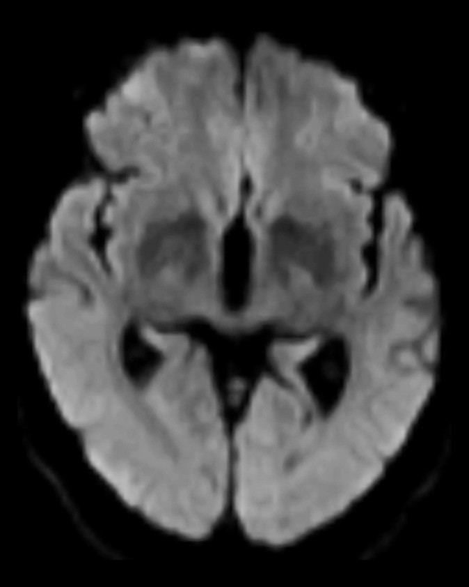 Figure 2 Brain MRI shows no signs of diffusion restriction